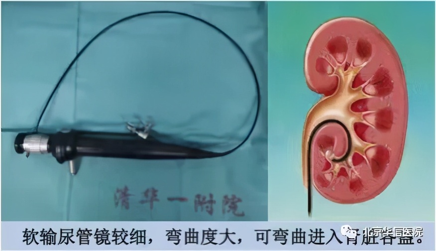 尿路结石ct复查,尿路感染进了icu