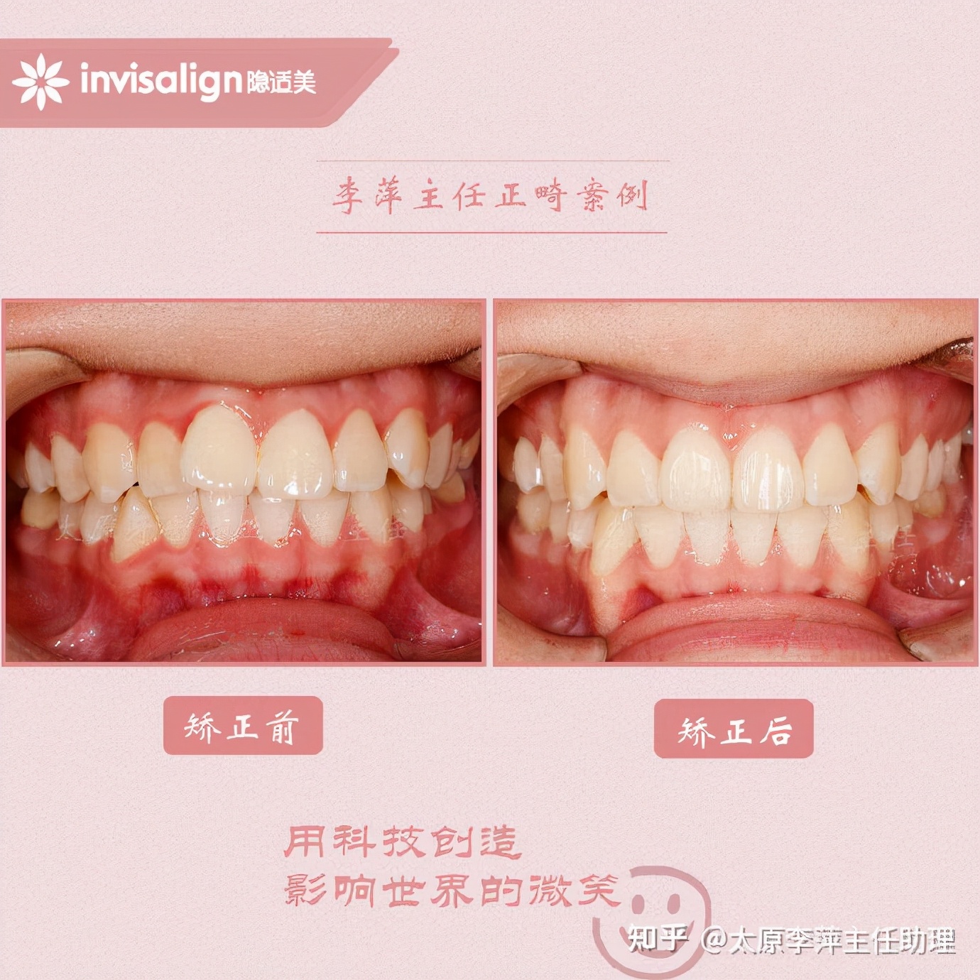 重度拥挤矫正牙齿适合隐形牙套吗,广州成人牙齿矫正推荐隐形牙套