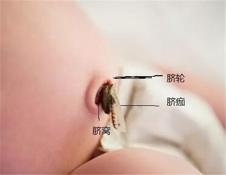 出生20天宝宝肚脐出血是怎么回事,新生儿脐带脱落后肚脐出血的护理