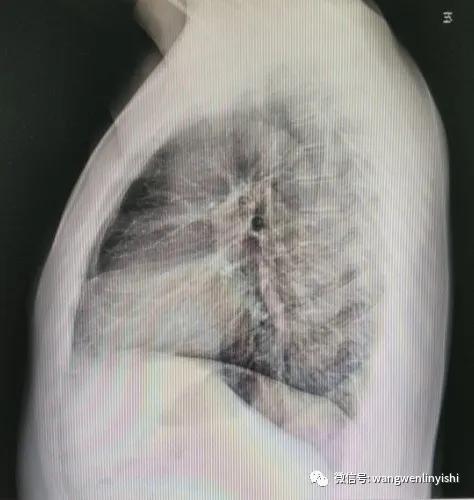 胸围超1米：重度桶状胸，Wenlin手术