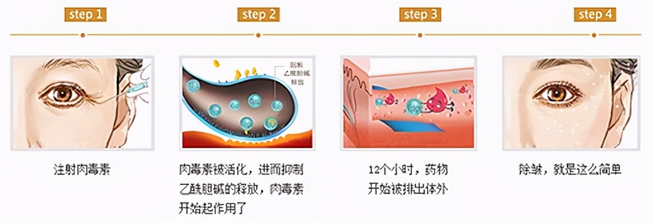 鱼尾纹至少有几条,鱼尾纹和眼角纹的区别图解