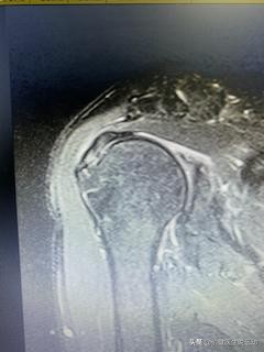 肩峰撞击综合征怎么办,游泳肩的治疗