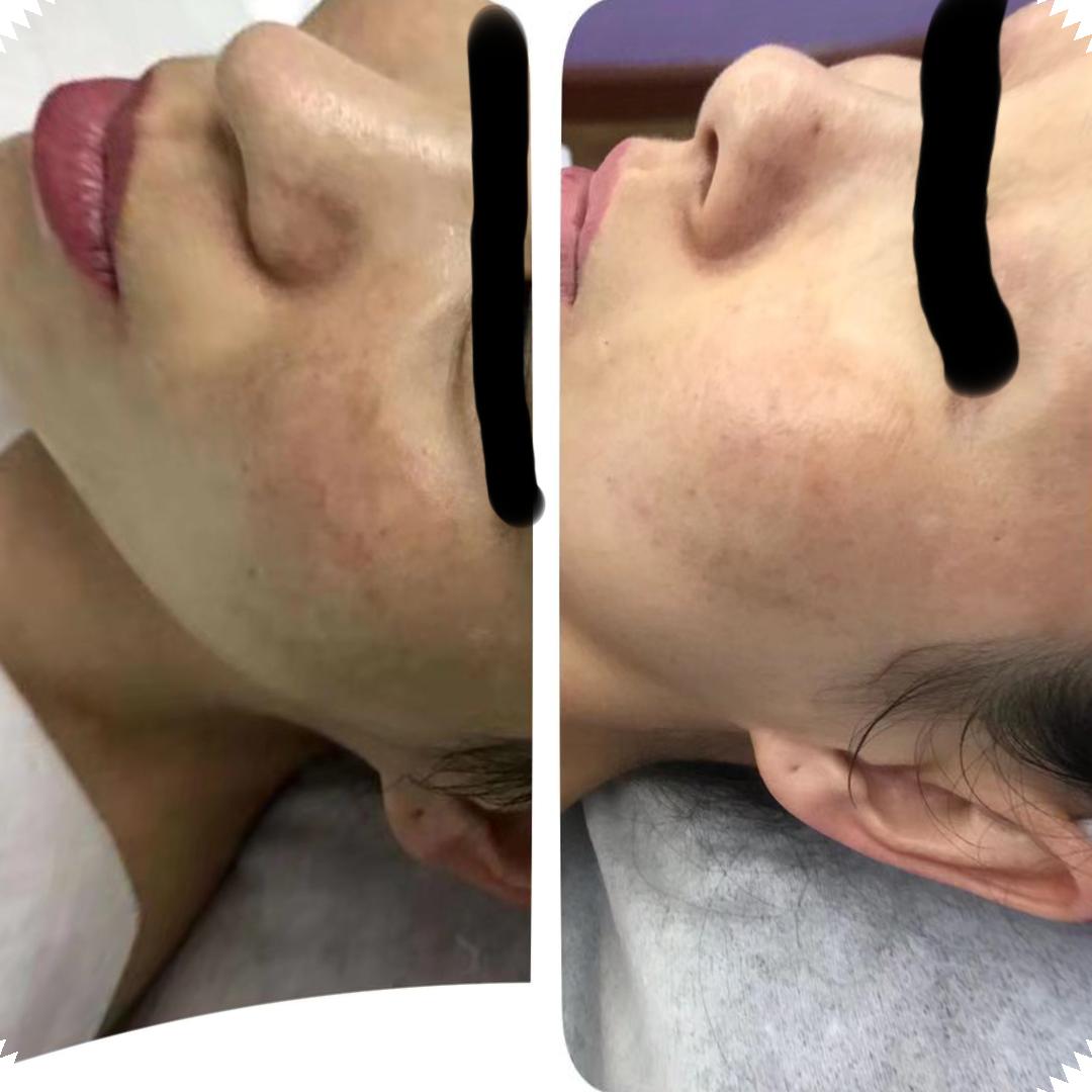 黑眼圈类型怎么辨别,黑眼圈类型怎么分辨