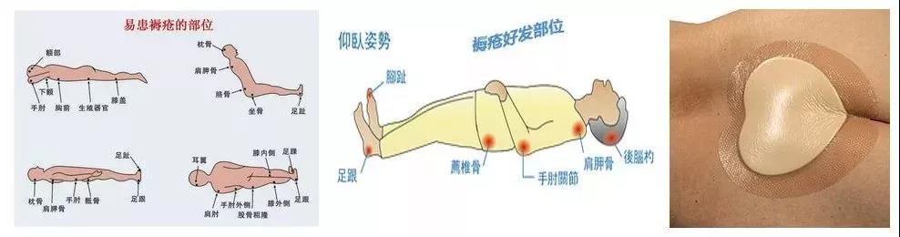 伤害老年人的第三大杀手！家中有老人跌到，髋部骨折该如何处理？