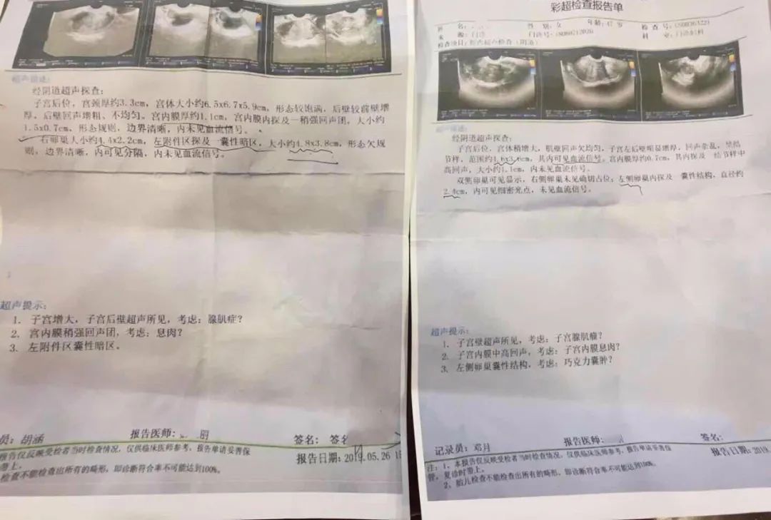 女性双侧输卵管通而不畅做理疗,双侧输卵管不通加多囊