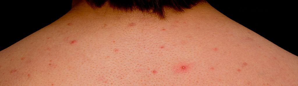 后背长痘不敢穿吊带,后背长痘不敢穿露肩衣怎么办