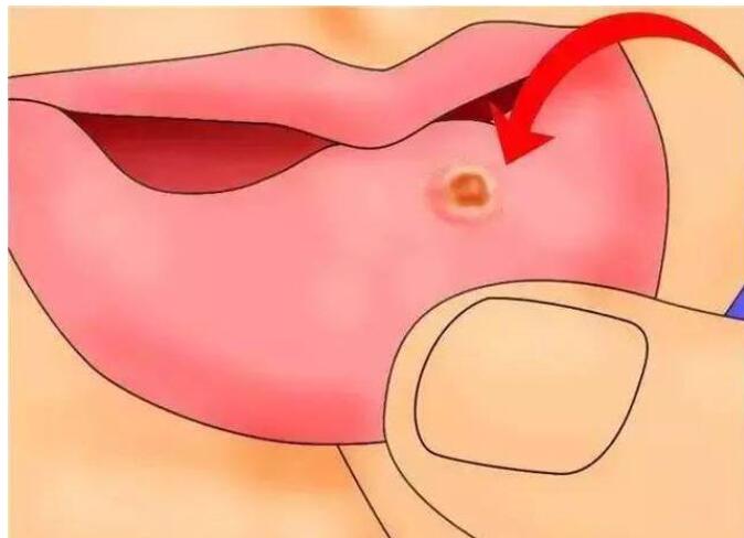 宝宝疱疹性咽峡炎一直哭闹,宝宝哭闹不喝药