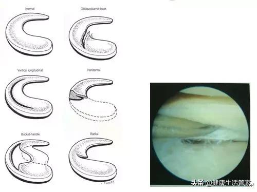 膝关节半月板撕裂怎么治,膝关节损伤科普知识