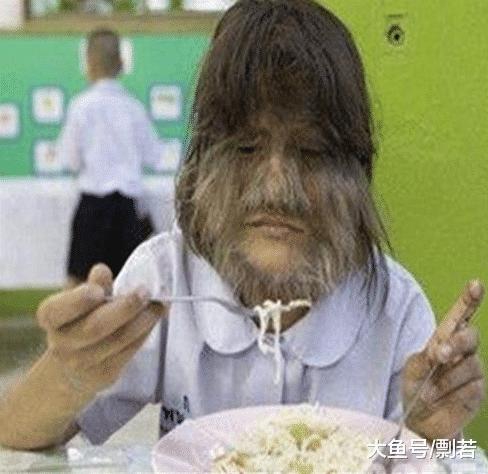 女孩突发怪病脸部疯狂生长,女孩患病满脸毛发