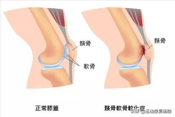 膝关节疼痛分类,膝关节疼痛是什么症状