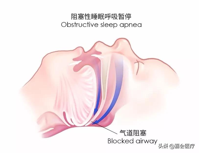 治好打鼾其实很简单的,通过手术能彻底治好打鼾吗