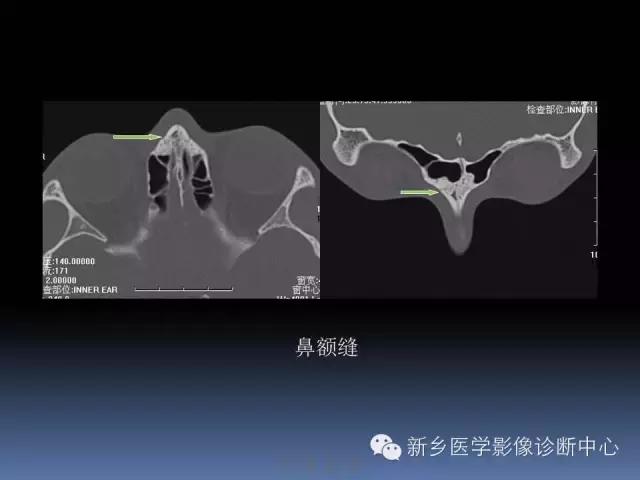 鼻骨骨折在ct片上的表现,鼻骨骨折ct怎么看