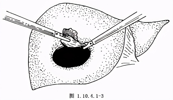 肝囊肿什么情况下要做手术呢,什么样的肝囊肿会自愈