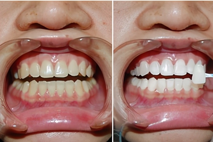 牙齿冷光美白和皓齿,皓齿美白大概多少钱