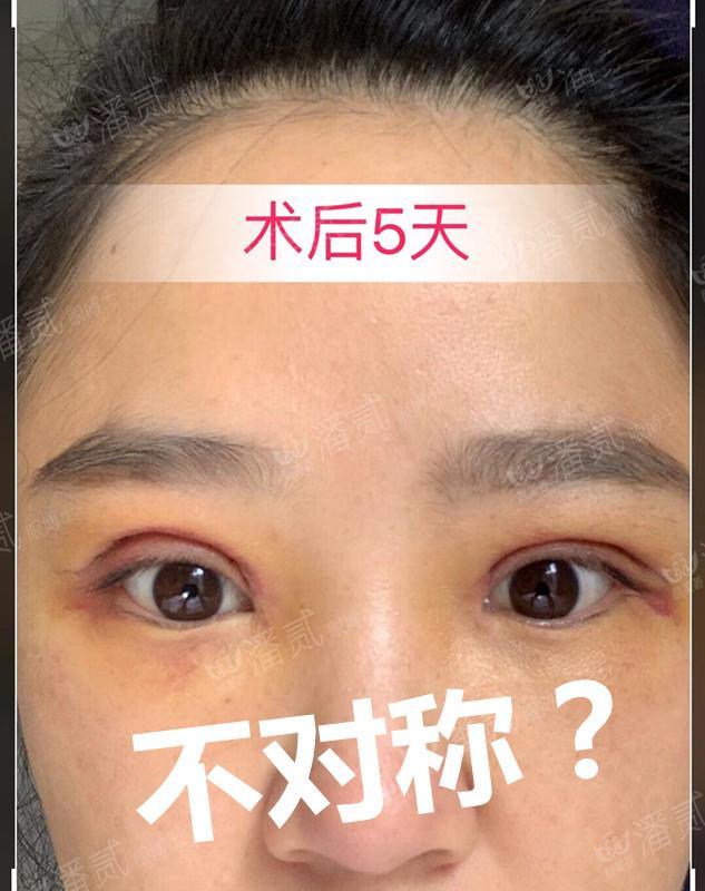 双眼皮修复要对医生说实话吗,双眼皮失败可以修复的几率有多大