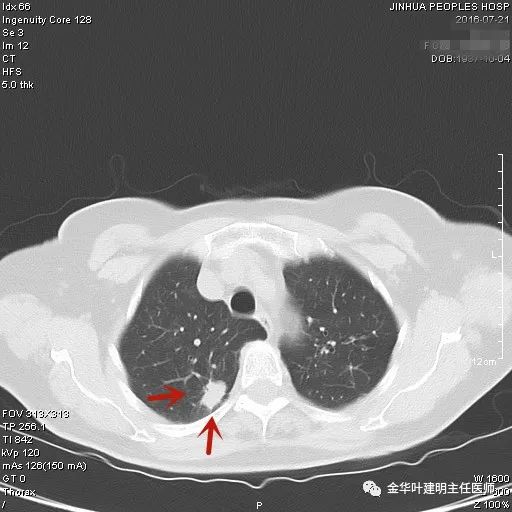 叶建明谈胸膜下的实性结节,叶建明肺实性良性结节会变癌症吗