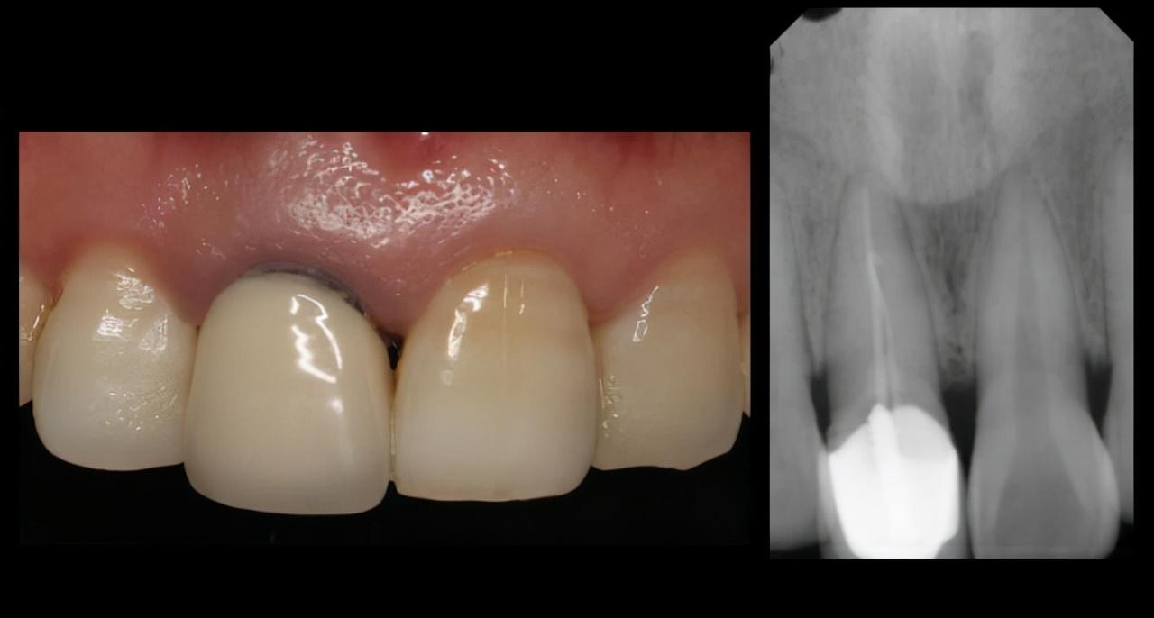 孩子摔一跤,小孩门牙摔断最好的方法怎么处理