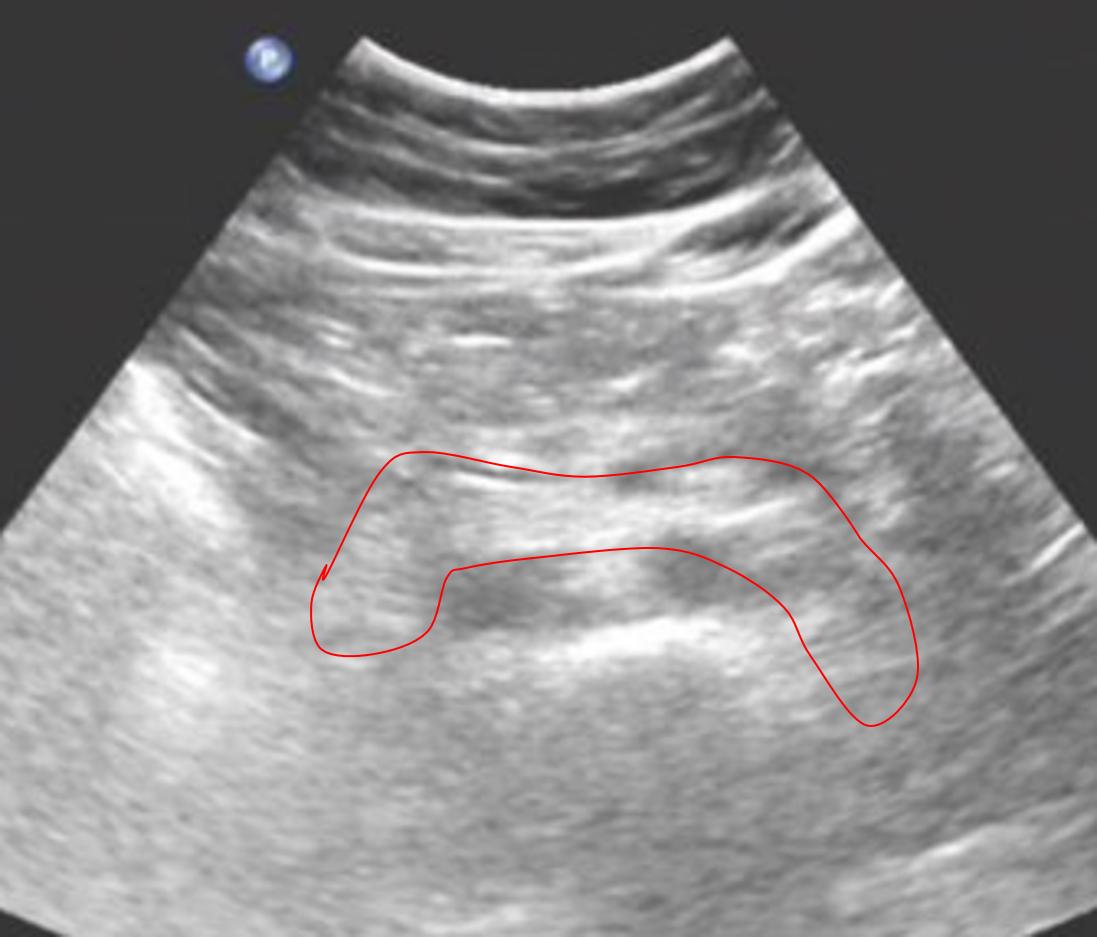 空腹做彩超能检查出什么,彩超为什么检查肝要空腹