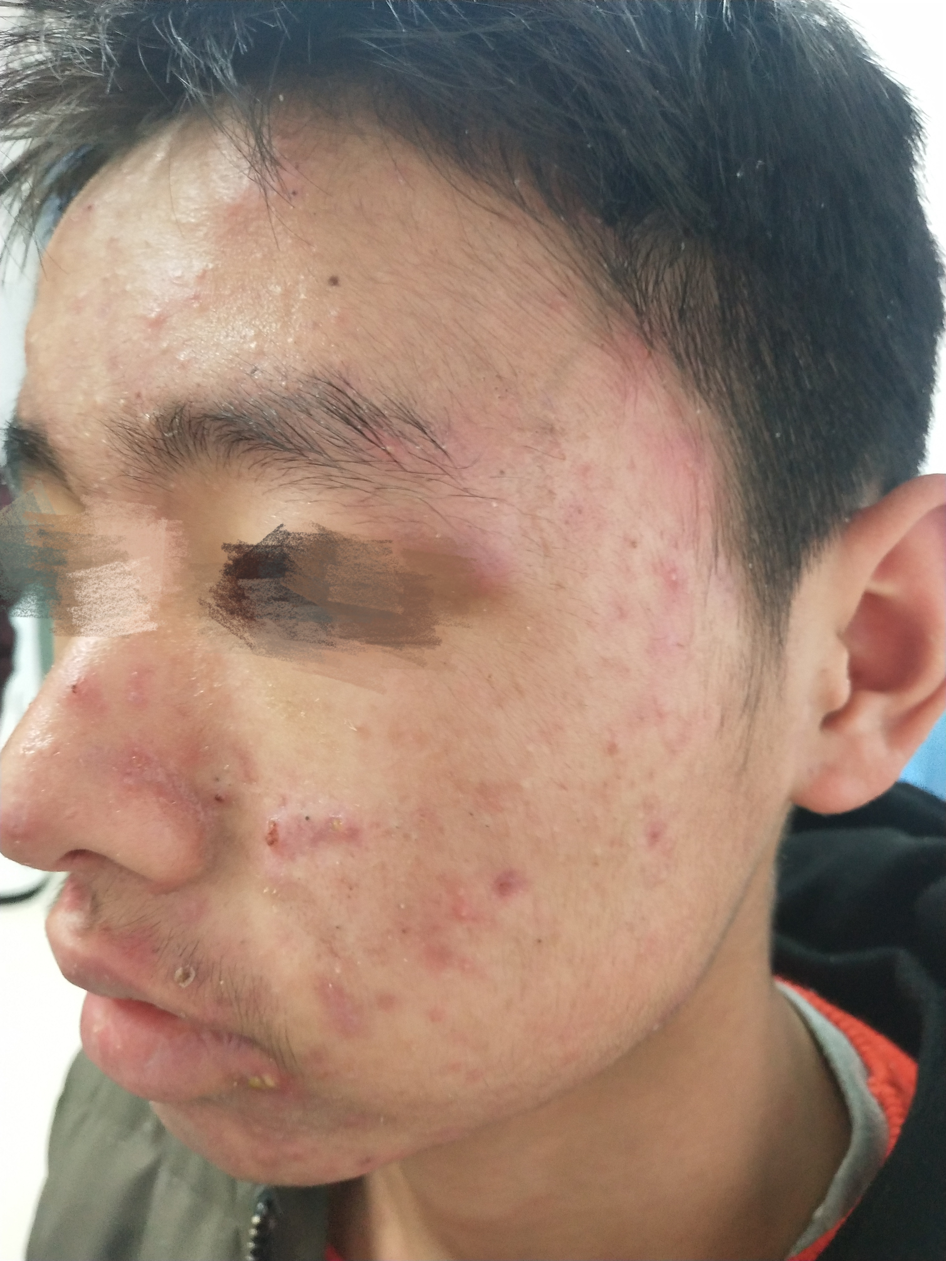 16岁男孩子脸部痘痘严重,16岁男孩身上长痤疮怎么治疗