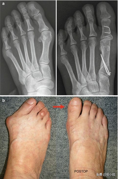 穿舒适又好看的鞋,穿什么样的鞋能修正腿型