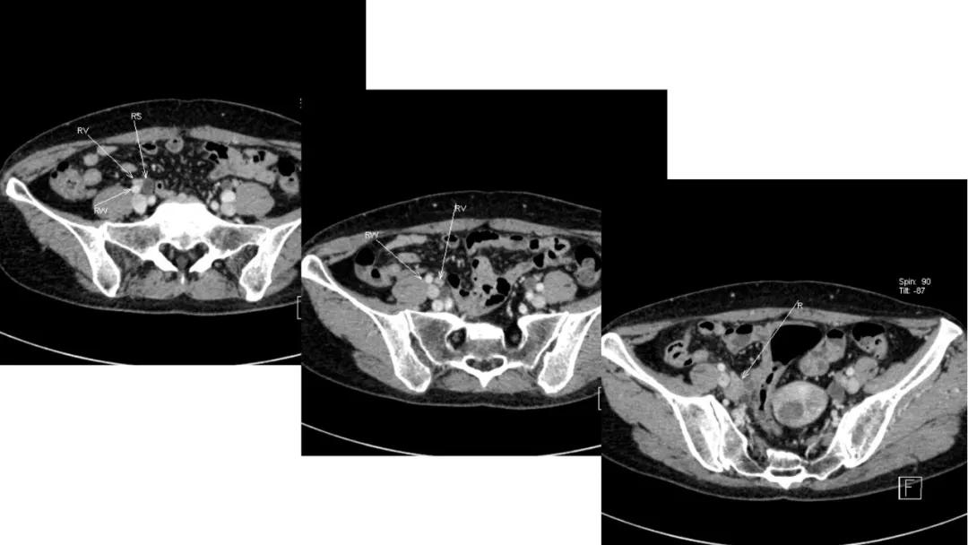卵巢原发肿瘤的分析思路