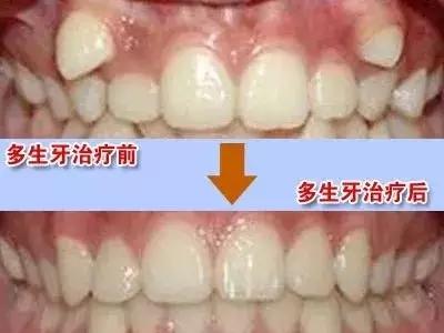 孩子多生牙怎么治疗,孩子多生牙怎么矫正