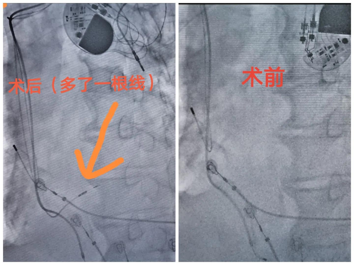 88岁老人心跳过快需要装起搏器吗,老人胸闷气短找中医看可以吗