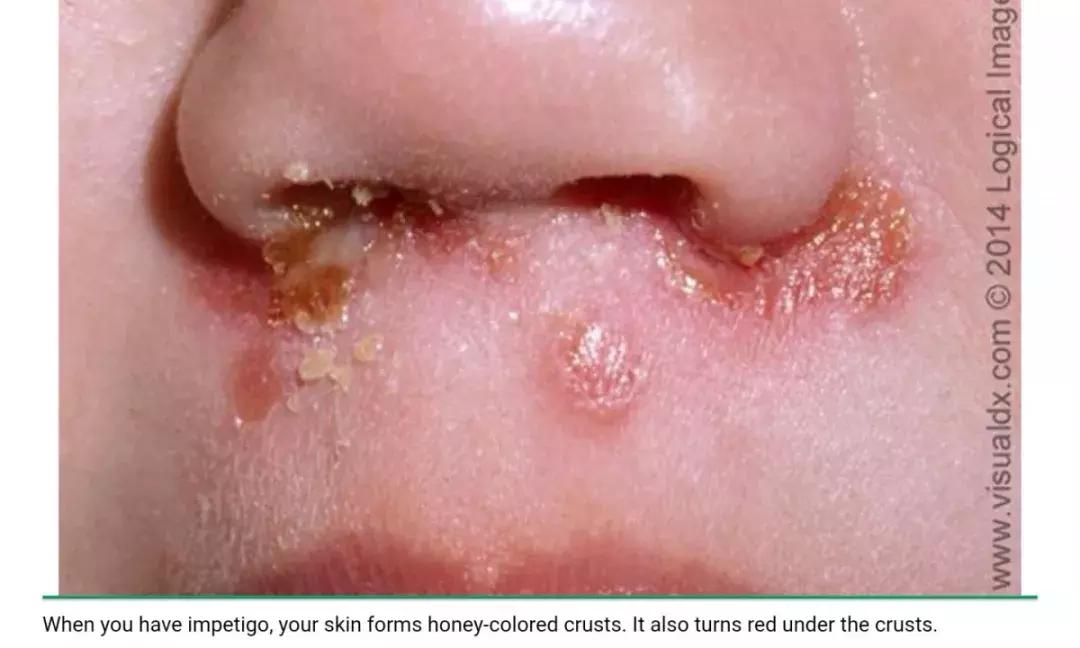 新生儿皮肤问题大全一览表,新生儿常见八大皮肤问题