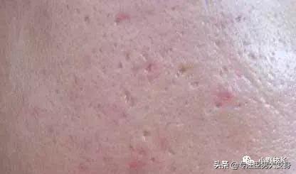 祛痘印最好的方法目前最有效的,祛痘印有效的精华