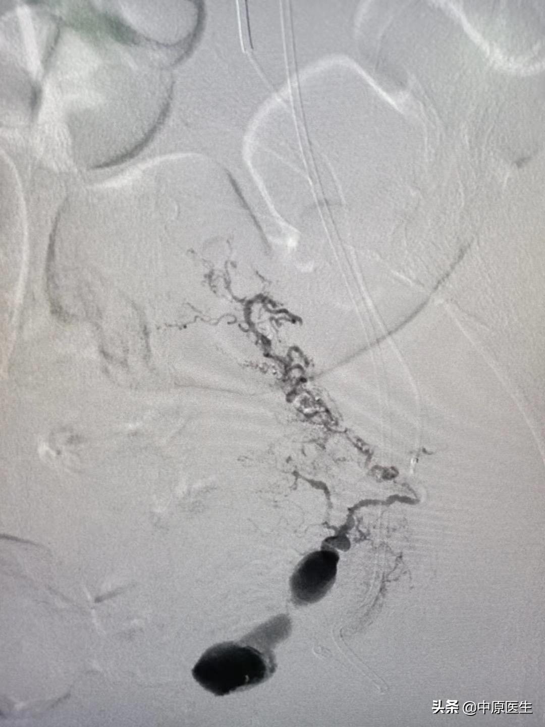宫颈鳞癌需要切除哪里,宫颈鳞癌出血怎么处理