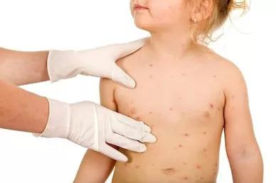 喝牛奶腹胀腹泻是怎么回事,喝牛奶长痘拉肚子怎么解决