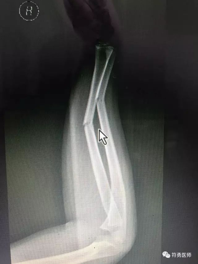 孩子骨折了一定要做打钢针手术吗,儿童摔伤骨折需要手术么