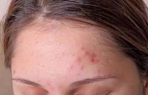 怎样有效消除脸上的痘痘,怎样去除脸上的痘痘和痘印