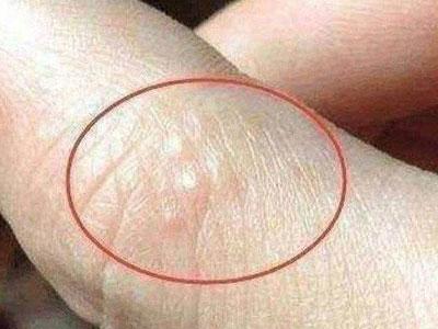 一到夏天手指上起小水泡痒怎么办,夏天脚背起小水泡很痒是怎么回事