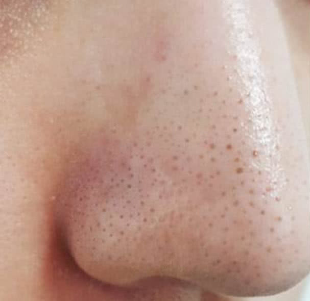 鼻子挤出一个洞怎么处理,鼻子挤出黄粒留下一个洞怎么处理