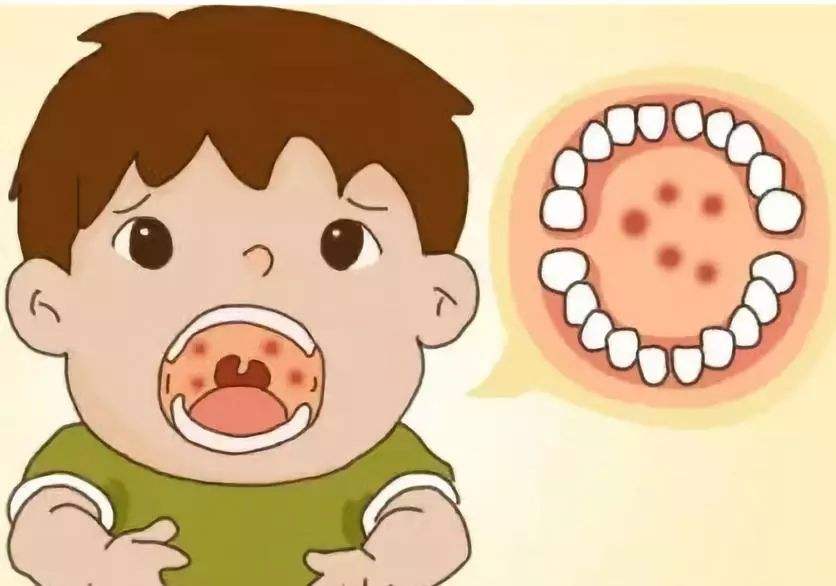 疱疹性咽峡炎吃小儿豉翘颗粒,疱疹性咽颊炎如何好得更快