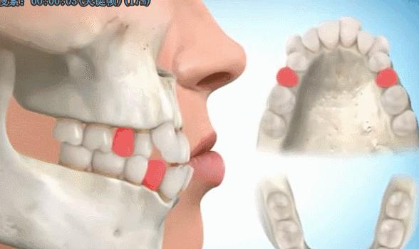 矫正牙齿可以改变小下颌吗,矫正牙齿可以改变脸型