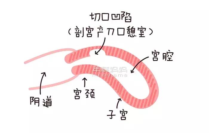 产后42天子宫偏大怎么恢复,小产后吃什么对子宫恢复快又好