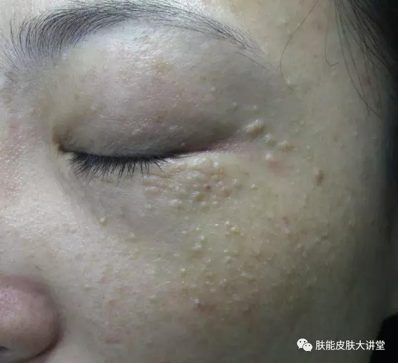 眼睑周围起脂肪粒怎么办,眼睑周围的脂肪粒怎么消除