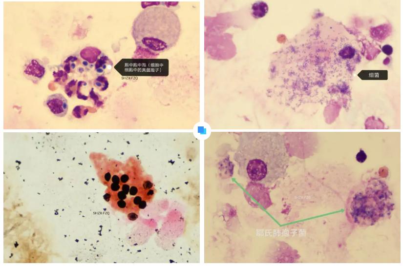 肺泡灌洗液细胞学检查“只需”看细胞吗？（续）