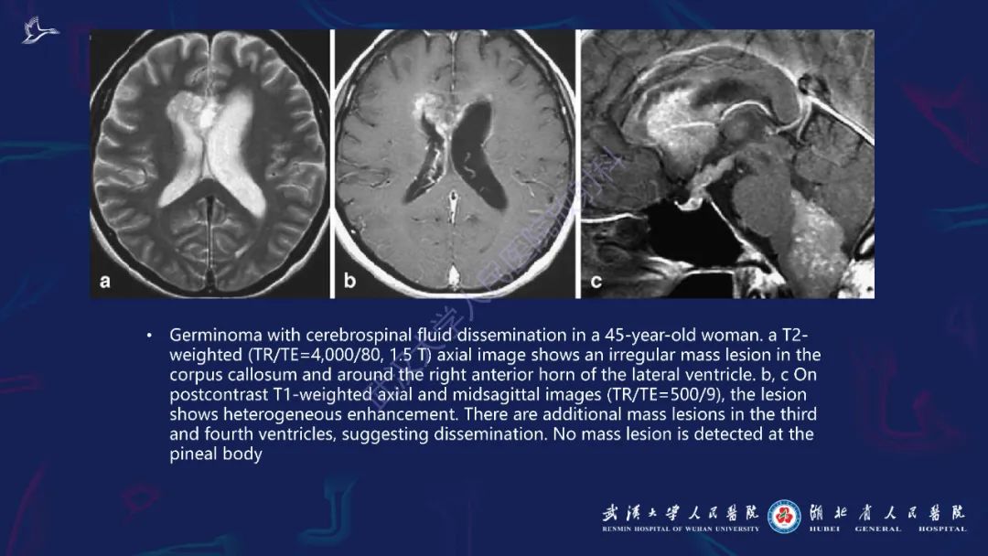胼胝体肿瘤影像鉴别,胼胝体病变影像诊断
