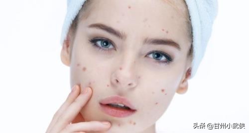 五十岁脸上长痘痘鼻子也长痘,脸上长痘痘身上长痘的原因