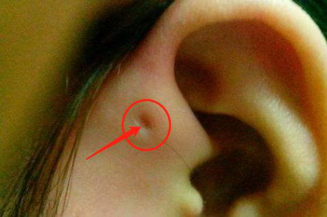 新生儿耳朵旁边有个小洞,耳朵旁边的小洞