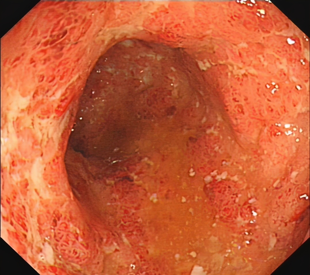 便秘溃疡性结肠炎怎么治疗,溃疡性结肠炎小腹疼痛便秘怎么办
