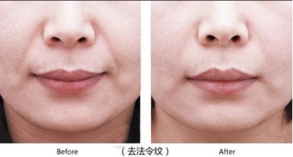 一招帮你搞定淡化法令纹,一招教你淡化法令纹