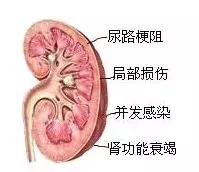 碎石完没有石头了腰还是疼,碎石后没感觉有石头排出来
