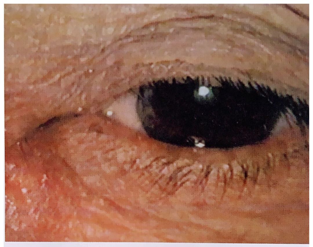 慢性泪囊炎用什么眼药水好,慢性泪囊炎手术费多少钱