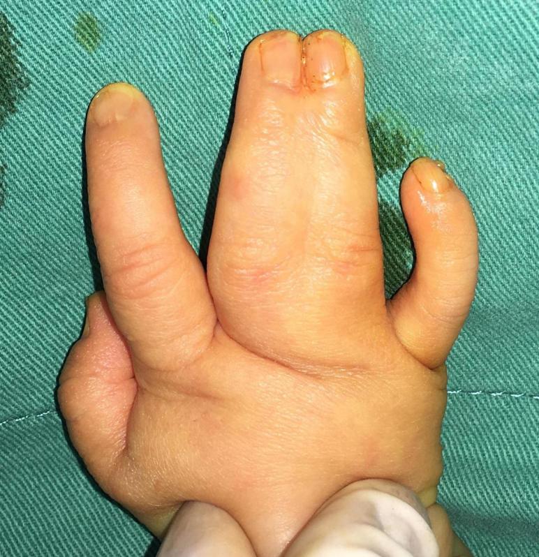 并指畸形免植皮案例,并指畸形