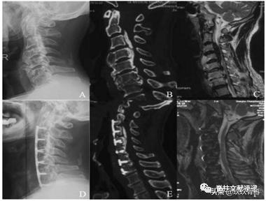 acaf手术适应脊髓型颈椎病吗,acaf术后康复方法