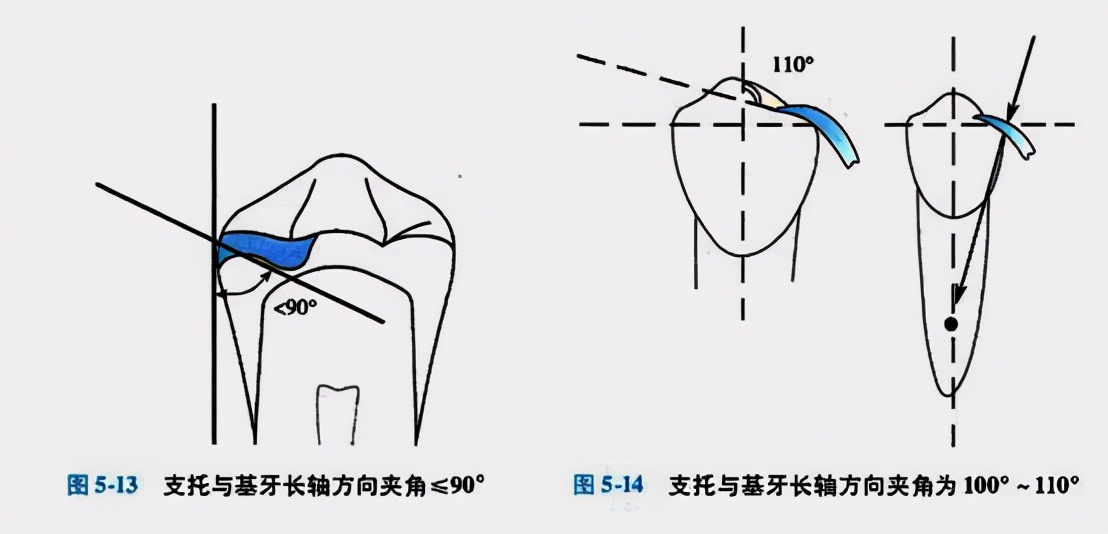牙列缺损的可摘局部义齿修复题库,牙科美学修复精讲